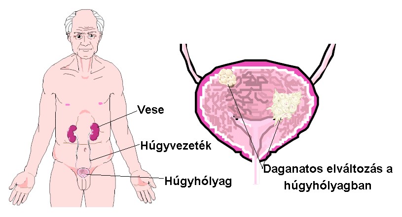 állandó vizelési inger lelki okai prostatitis patogenezis